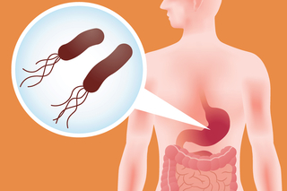 H. pylori is a common bacterium found in the human stomach.